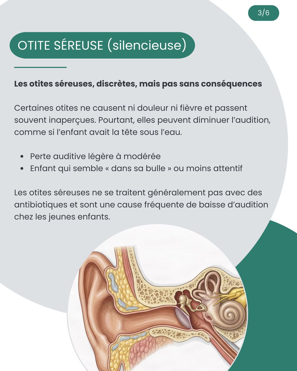 Page 3 du guide : otite séreuse silencieuse